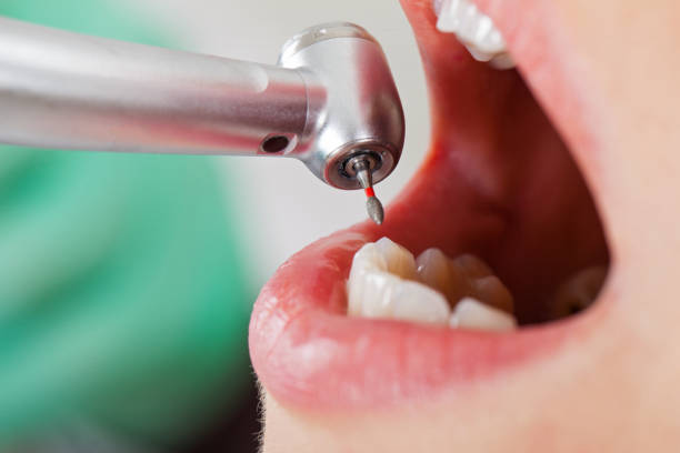 Best Emergency Broken Tooth Repair in Exmore, VA